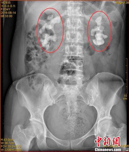 四川一女子喝生水30余年雙腎長10厘米巨型結(jié)石