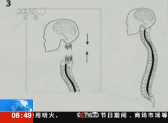 首例人類“換頭”手術將實施：比死還難受