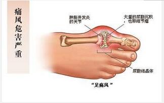 痛風病人吃什么好？ 飲食需合理搭配